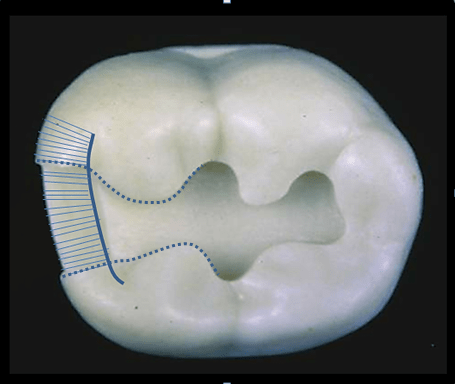 Image of buccal and lingual walls of a tooth