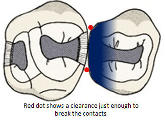Image of buccal and lingual extensions of the proximal box