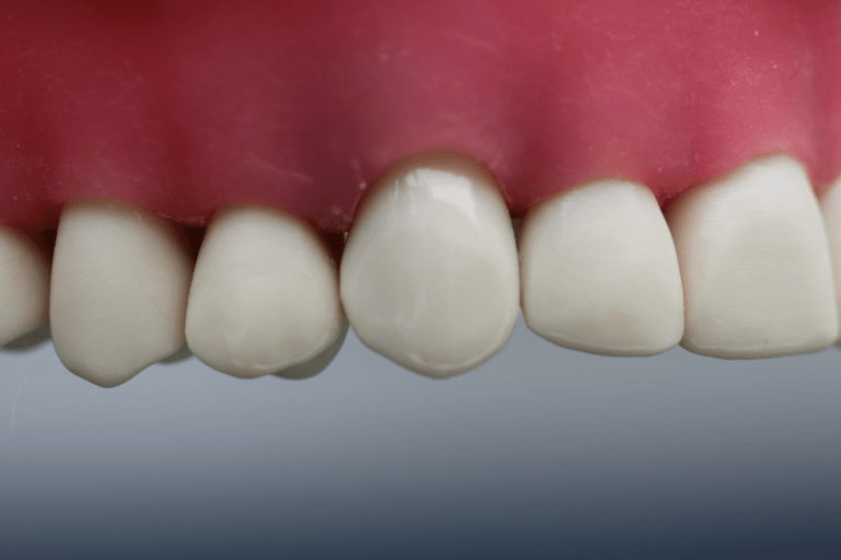 Image of upper canine
