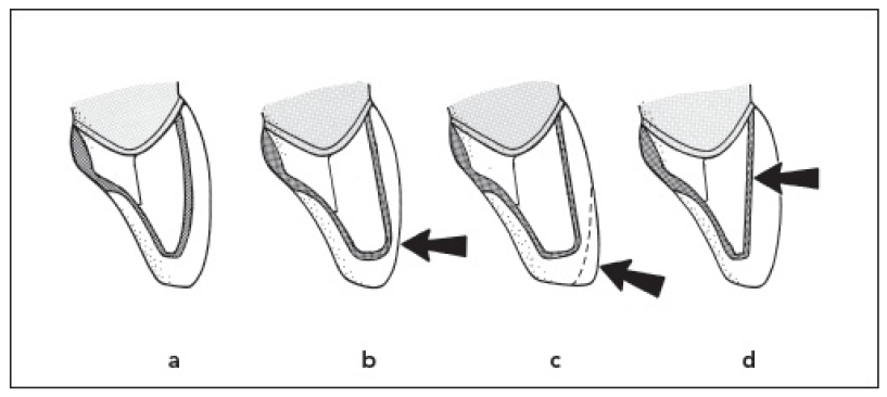 Image of labial reduction