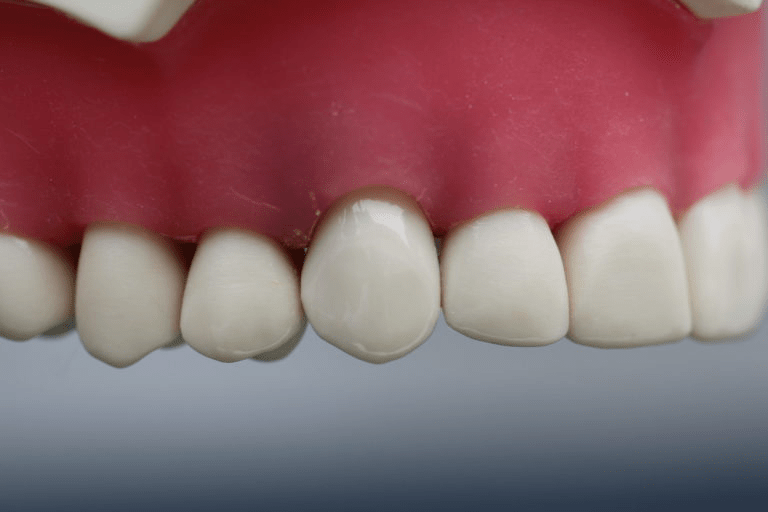 Image of Upper Canine labial