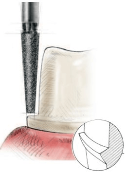 Image of shoulder in basic forms of finish lines