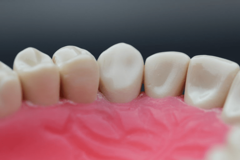 Image of Upper Canine Lingual