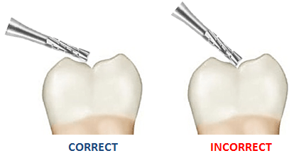 Image of angulation of your bur