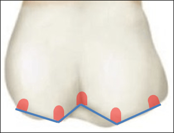 Image of the adjacent tooth