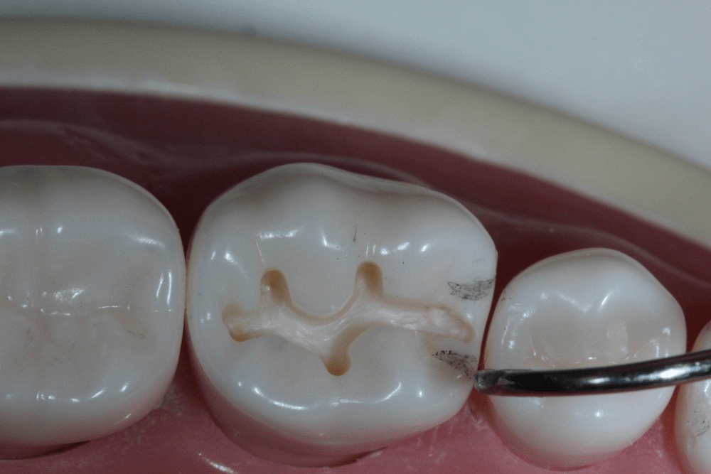 Image of making a proximal box