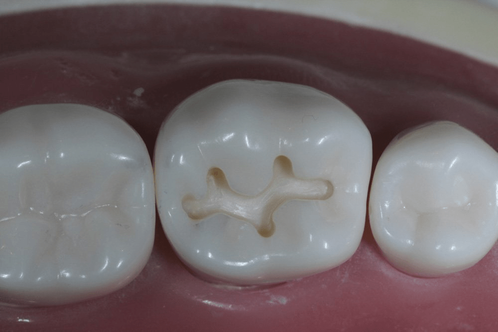 Image of making a proximal box