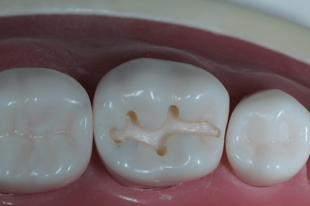 Image of making a proximal box