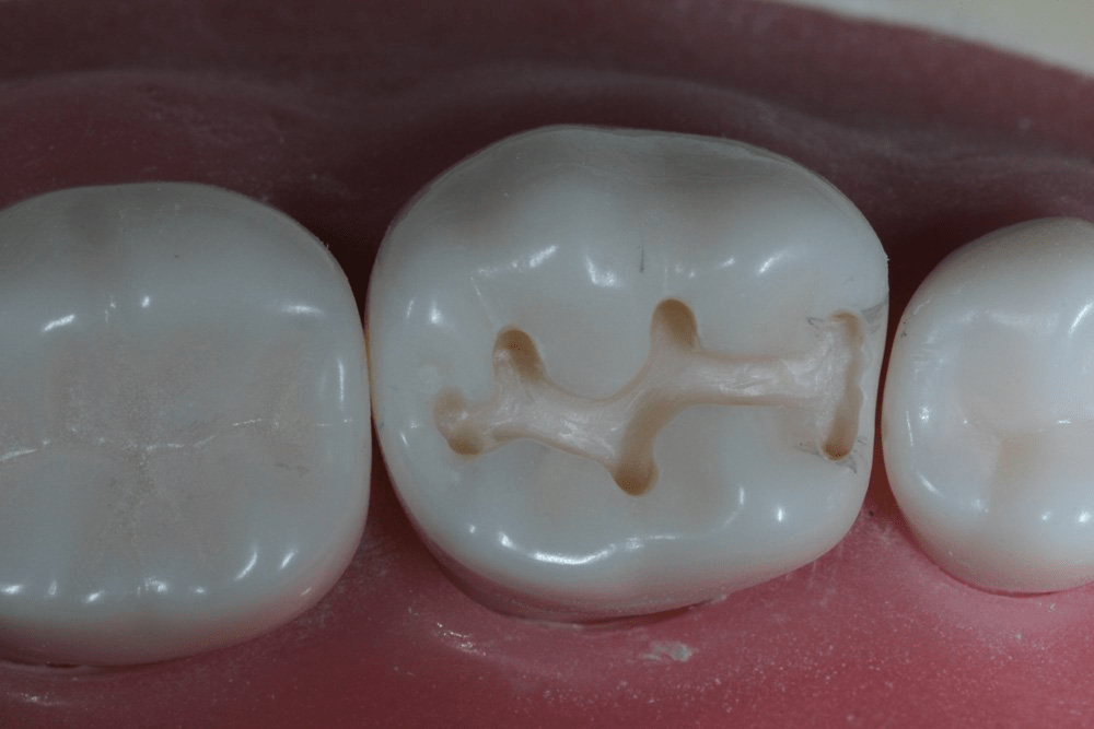 Image of making a proximal box