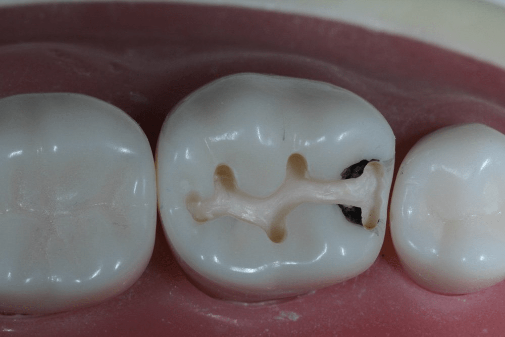 Image of making a proximal box