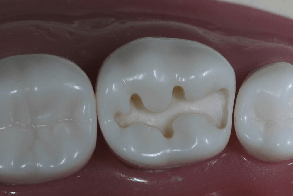 Image of making a proximal box