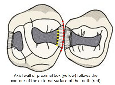 Image of proximal wall external surface