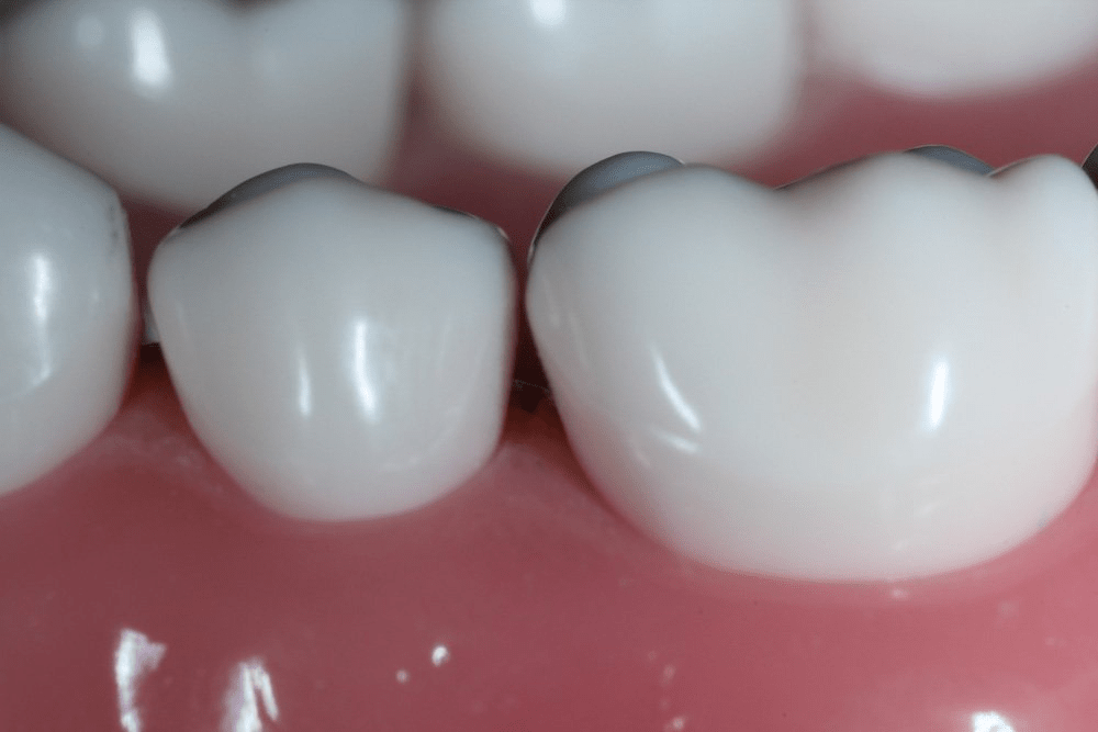 Image of making a proximal box