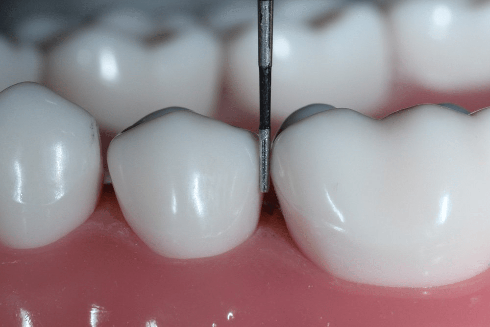 Image of making a proximal box