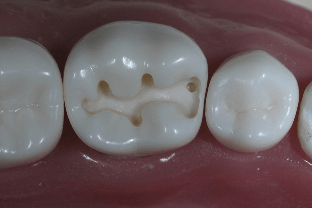 Image of making a proximal box