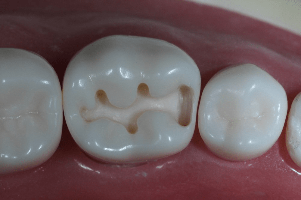 Image of making a proximal box