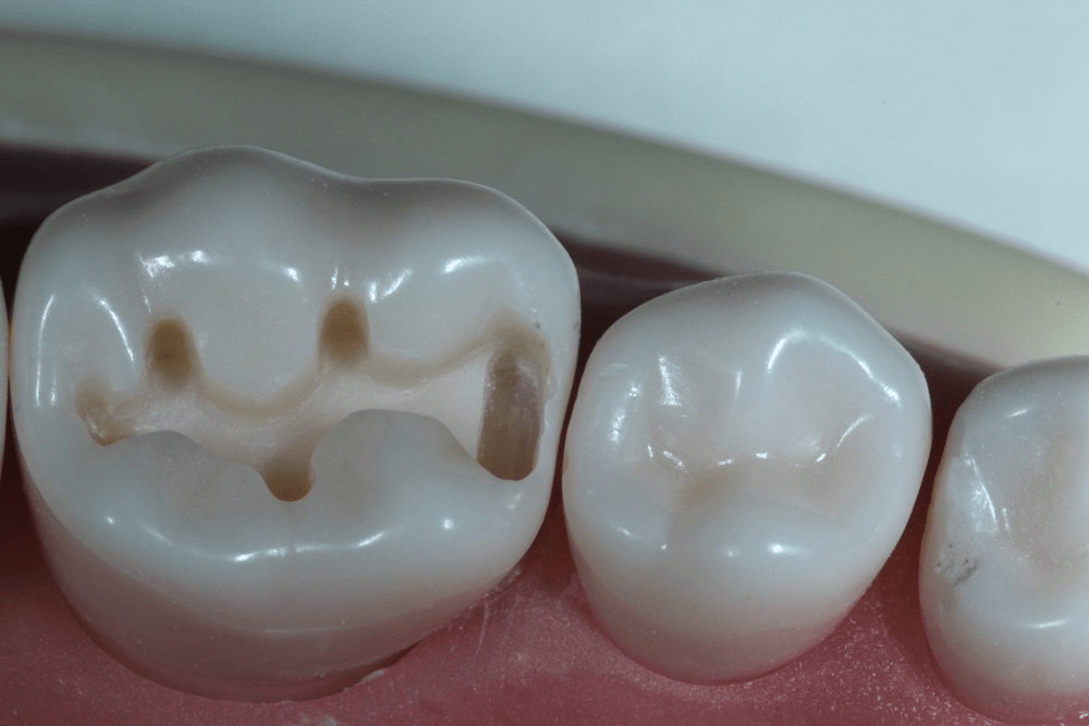 Image of making a proximal box
