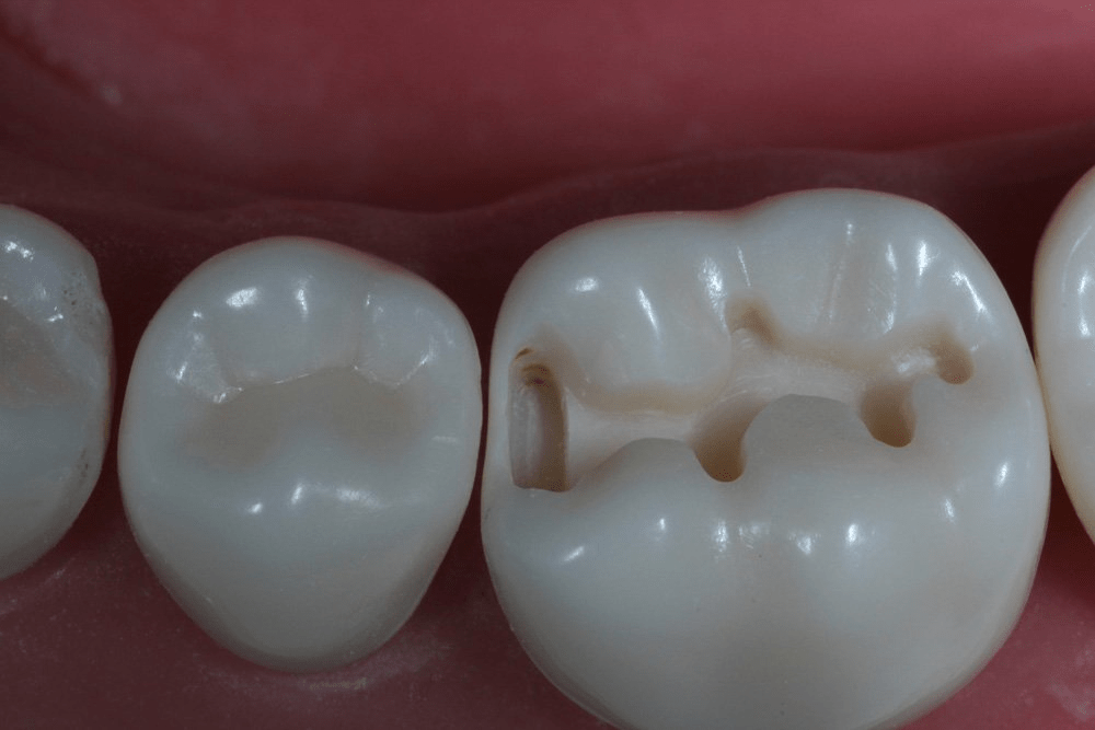 Image of making a proximal box