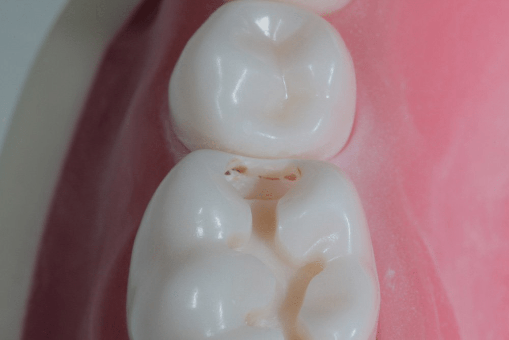 Image of making a proximal box