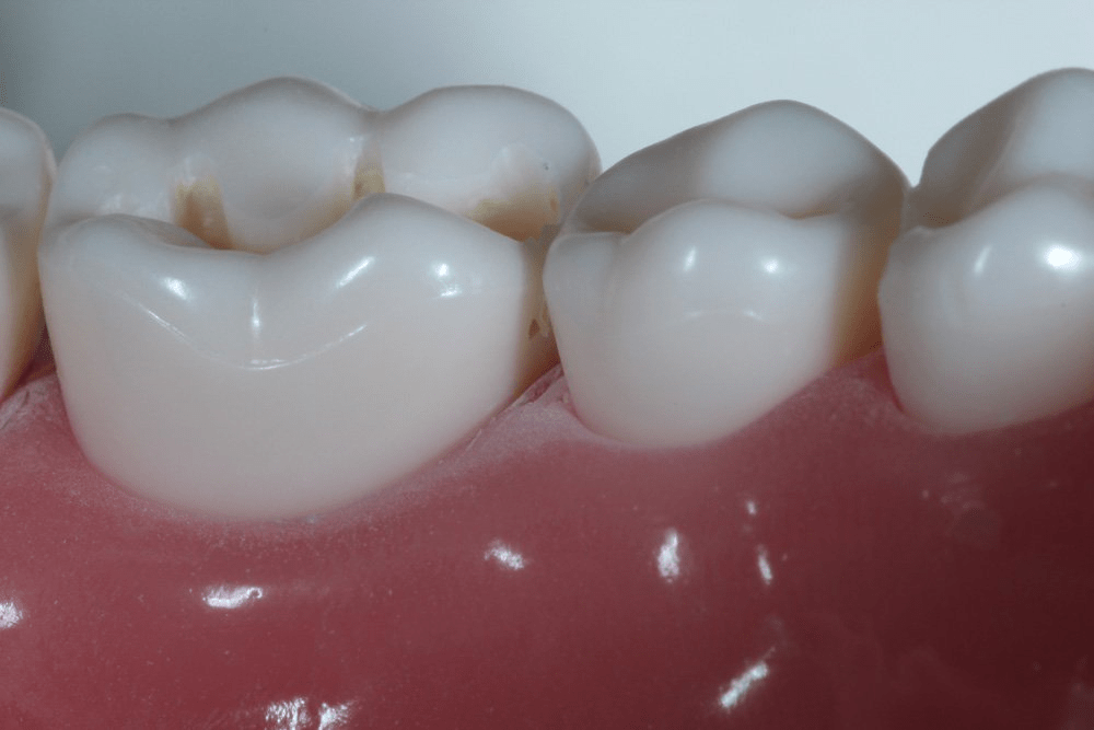 Image of making a proximal box
