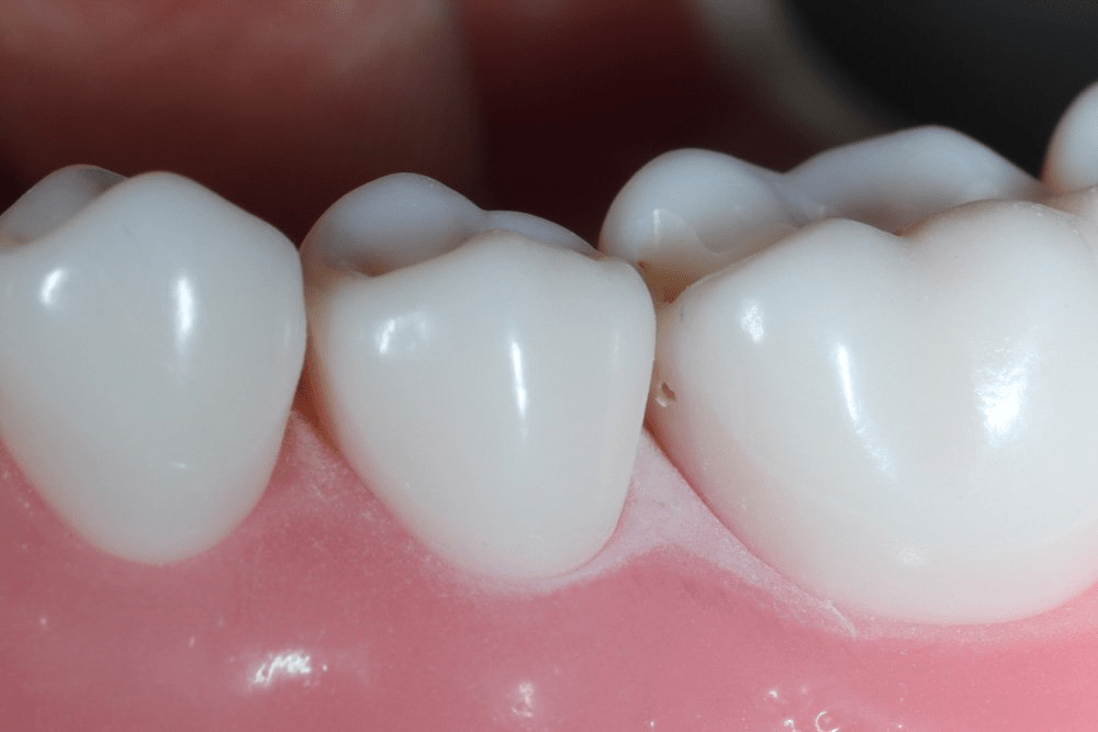 Image of making a proximal box