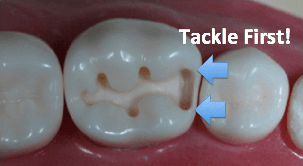 Image of making a proximal box
