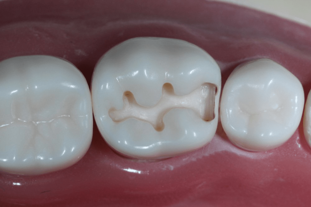 Image of making a proximal box