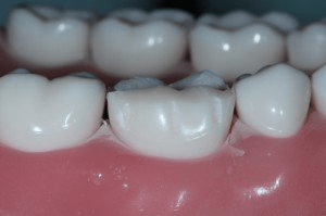 Image of buccal reduction