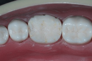Image of buccal reduction