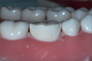 Image of Creating Chamfer Margins