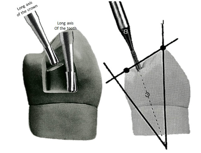 Image of angulation of bur proximal