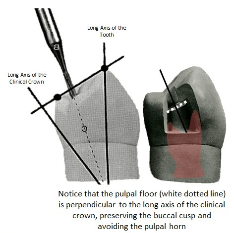 Image of pulpal floor