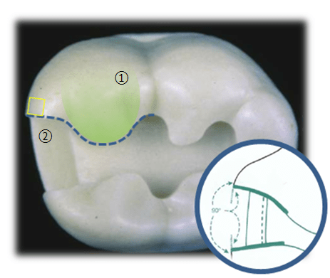 Image of a Reverse-S Curve on a tooth